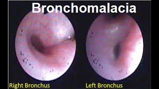 Bronchomalacia Treatment  Symptoms and Causes  Diagnosis  Prevention disease healthcare [upl. by Nodnarbal]