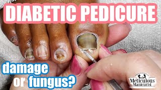 Diabetic Pedicure Toenail Damage or Nail Fungus [upl. by Eelirol]