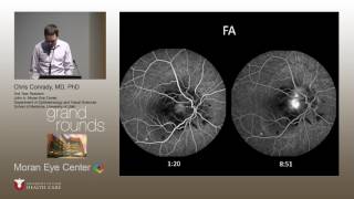 Optic Disc Edema and Choroidal Neovascular Membranes [upl. by Neyut604]