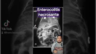 Enterocolitis necrosante ⚠️🧑‍⚕️ pediatrics intestino medico sabiasque medstudent med [upl. by Olimreh]