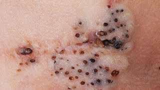 Most Satisfying Video HD How to Remove Giant Blackheads 010 [upl. by Krys]