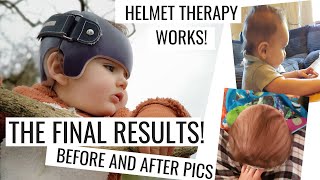 Flat Head Syndrome Helmet TherapyFinal ResultsPlagiocephalyBrachycephaly [upl. by Eanahc]