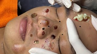 blackheads new 2023  popping pimple today  blackheads and whiteheads removal [upl. by Loria]