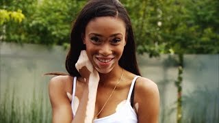 How a Model with Vitiligo Ignored Bullies and Became an Inspiration to All [upl. by Zeiger]