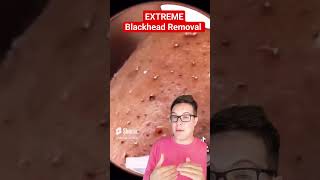 Crazy Huge  BIGGEST BLACKHEAD REMOVAL 2024 So Far shorts [upl. by Pardew608]