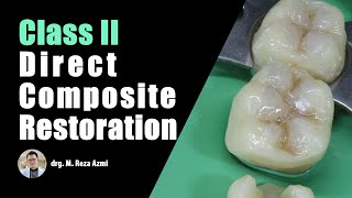 Class II Direct Composite Filling Posterior Restoration  Operative Dentistry  VOCO Polofil NHT [upl. by Hazaki]