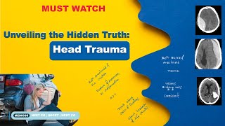 Head trauma Basics of head trauma and it’s radiology  EDH  SDH IPH  IVH  bleeding in the brain [upl. by Oswal]