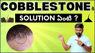 AskDrJohnWatts  COBBLESTONE కి SOLUTION ఏంటి   Hair Specialist Explains [upl. by Eiliah]