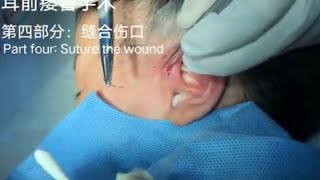 Preauricular Fistula Surgery（Part fourSuture the wound）耳前瘘管手术（第四部分：缝合伤口）20230815 [upl. by Aneeram723]