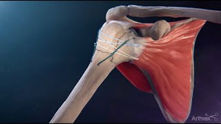 FxBridge™ Tuberosity Repair System Reverse Total Shoulder Arthroplasty [upl. by Uy729]