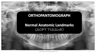 SOFT TISSUE LANDMARKS IN OPG [upl. by Caraviello]