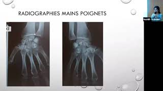 « Cas cliniques polyarthrite rhumatoïde » Dr SAbdellaoui [upl. by Ethbinium]