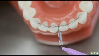 How to use interdental brushes under fixed retainer wire  Evolution Orthodontics [upl. by Redneval582]