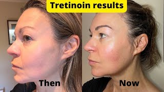 Dermatica tretinoin 6month results update  plus how to manage sun sensitivity [upl. by Carmine]