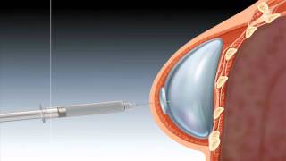 Tissue Expander for Staged Breast Reconstruction [upl. by Pavkovic35]