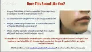 Angular Cheilitis Neosporin  Angular Cheilitis Treatment [upl. by Pudens]