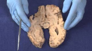 Basal Ganglia Neuroanatomy Video Lab  Brain Dissections [upl. by Kcirdet516]