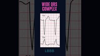 ECG FUNDAMENTALS FOR BEGINNERS QRS COMPLEX [upl. by Aillicsirp974]