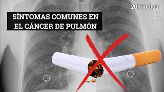 SÍNTOMAS DE ALERTA en el CÁNCER DE PULMÓN [upl. by Zsa]