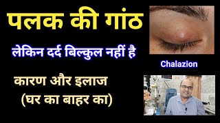 पलक में गांठ  कारण  इलाज  घर का बाहर का  Home Remedies Chalazion [upl. by Prentice]