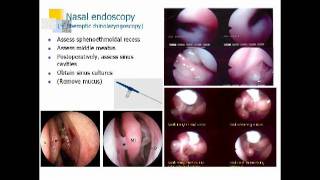 Sinusitis and Nasal Polyps Dan Hamilos MD [upl. by Esinahs653]