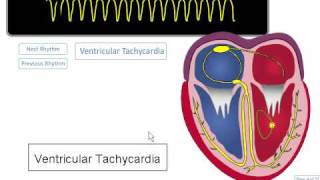 ECG Rhythm Review Ventricular Tachycardia Torsades de points Asystole [upl. by Azalea]