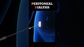 Peritoneal Dialysis Procedure shorts dialysis [upl. by Adidnac568]