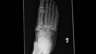 Lisfranc Fracture Dislocation [upl. by Ccasi40]