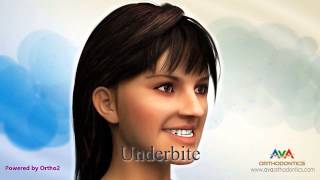 Malocclusion  Different Types [upl. by Beilul]