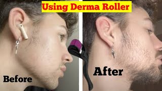 How to Grow Beard with a Derma Roller  Derma Roller For Beard Growth  beard grow kaise kare [upl. by Admama692]