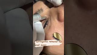 SYringoma removallaser treatmentlaserco2laser [upl. by Ayotahs483]