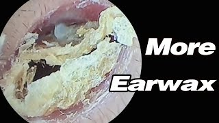 Ear Picking Earwax Is Super Heavy And Its Blocking My HearingASMRearwax耳掃除 [upl. by Siward297]