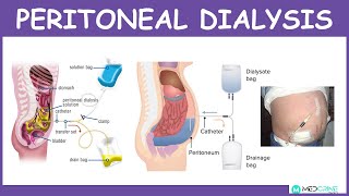 Peritoneal Dialysis Introduction Physiology Technique Modes and Complications [upl. by Clarine696]