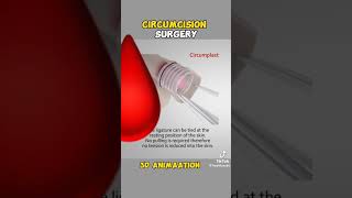 Understanding Circumcision Animated Surgery amp Real Insightsquot [upl. by Banyaz]