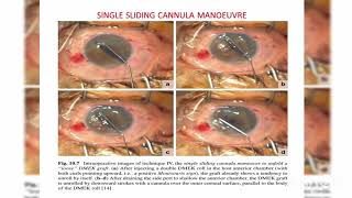 Endothelial keratoplasty DMEK DSEK DLEK PDEK Ophthalmology [upl. by Silver]