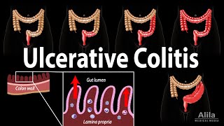 Ulcerative Colitis Pathophysiology Symptoms Risk factors Diagnosis and Treatments Animation [upl. by Fritzie]