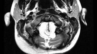 Spinal Lipoma Cervical [upl. by Clevey]