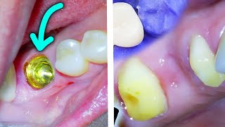 🦷 Dental Bridge vs Implant Dentist Explains Pros Cons amp How Each Is Done [upl. by Dene]