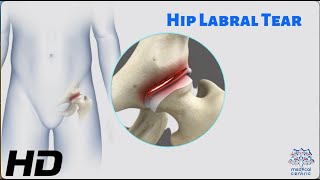 Hip Labral Tear The Hidden Culprit of Hip Pain [upl. by Anirbys]