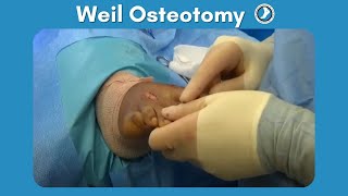 Weil Osteotomy Performed by Dr Paul Steinke [upl. by Even]