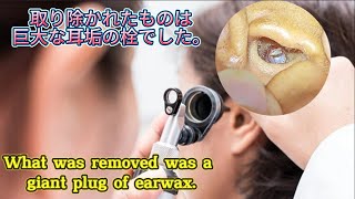 What was removed was a giant plug of ear earwax [upl. by Annuhsal]