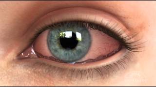 Conjunctivochalasis CCH Dry Eye Animation [upl. by Aneleve]