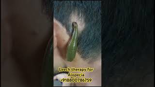 “Revolutionary Alopecia Treatment Natural Leech Therapy for Hair Regrowth” [upl. by Cornelie]