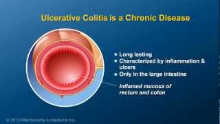 What is Ulcerative Colitis [upl. by Moorish843]