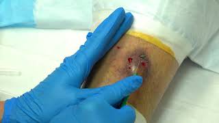 Thornys Leg Abscess Extended Raw Cut by MetaSeven [upl. by Leinnad]