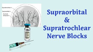 Anesthesia Technique for Blocking the Supraorbital and Supratrochlear Nerves [upl. by Notffilc]