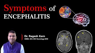 Encephalitis Symptoms Early Warning Signs You Shouldnt Ignore  Dr Ragesh Karn encephalitis [upl. by Rossner]