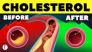 10 Natural Ways to Clear Your Artery  High Cholesterol  LDL  HDL  Heart Attack prevention tips [upl. by Oiratnom]