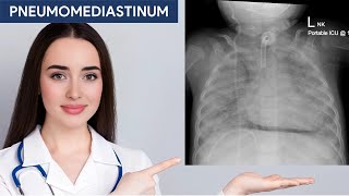 Pneumomediastinum in Chest X ray [upl. by Aldercy]