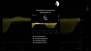 Echocardiography board practice question 29 [upl. by Liagiba191]